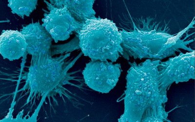 Prostate cancer patients eating ‘western’ diet more likely to die from disease