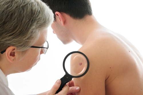 Erectile Dysfunction drugs do not increase risk of melanoma