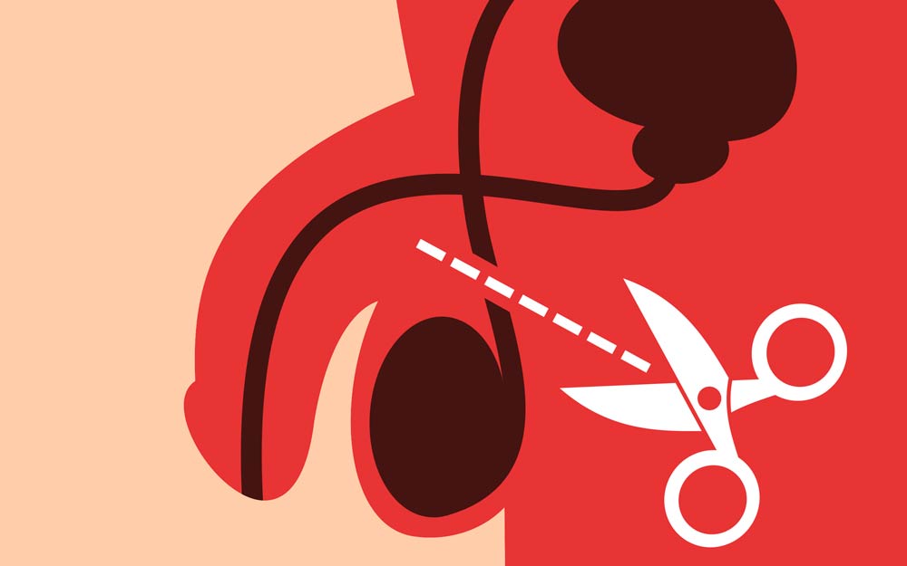 Sterilisation (Vasectomy or Tubal Ligation)